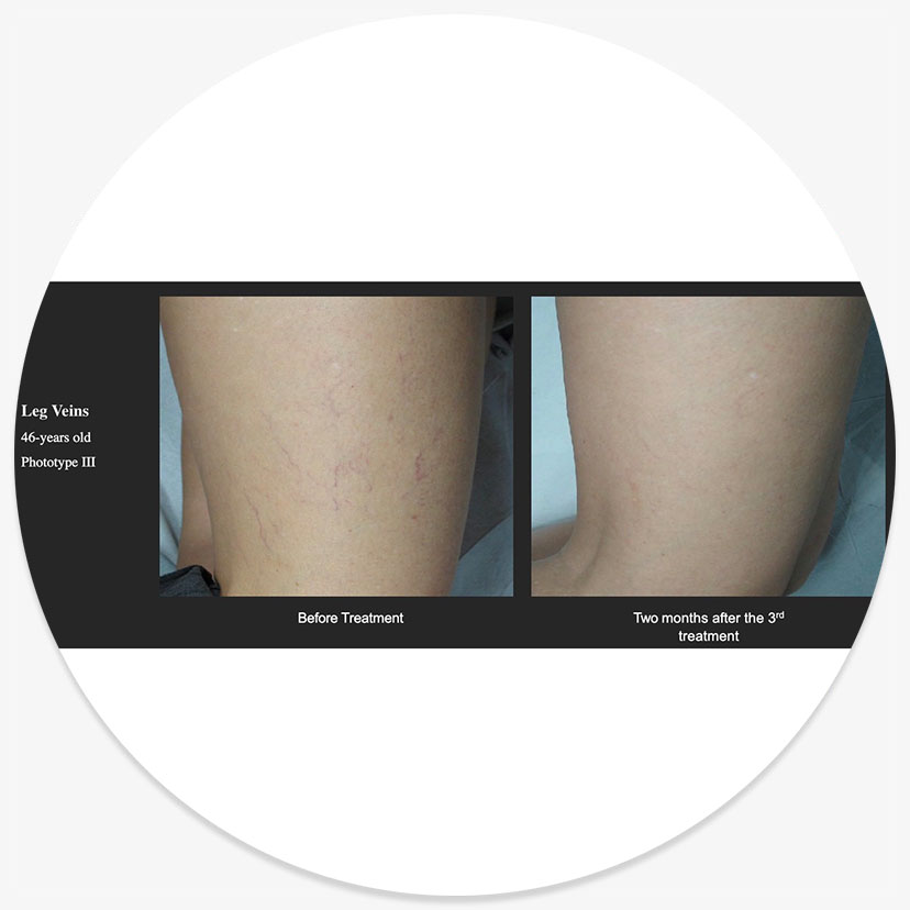 AlloraPro Laser Hair Removal - Epion Aesthetics and Wellness