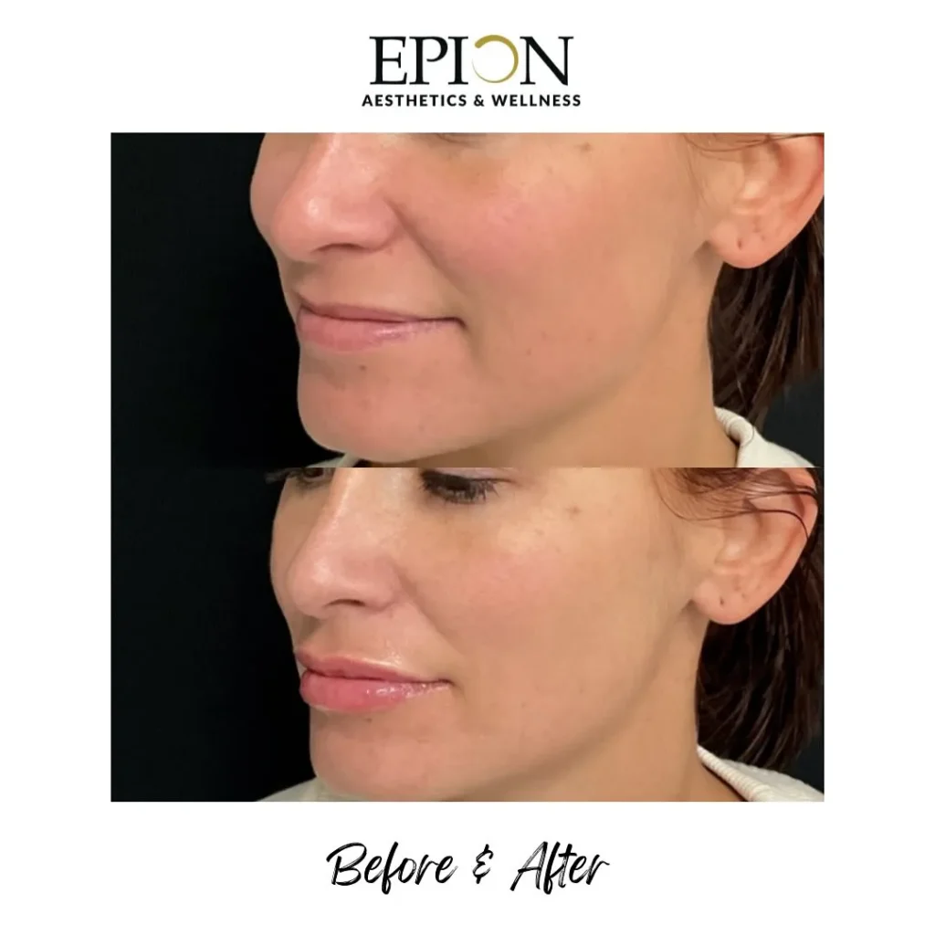 before and after of lip filler service