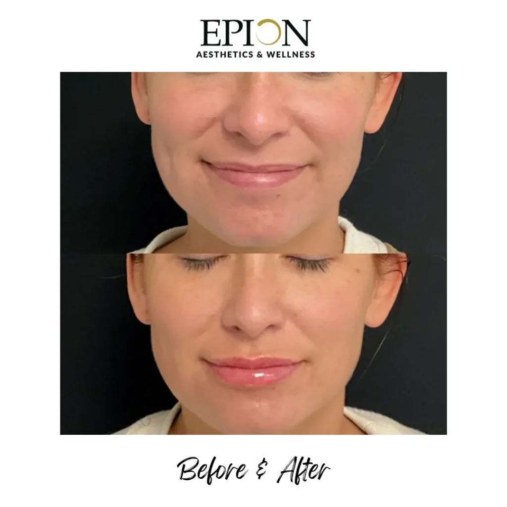 before and after of lip filler service