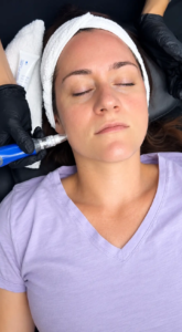 Microneedling